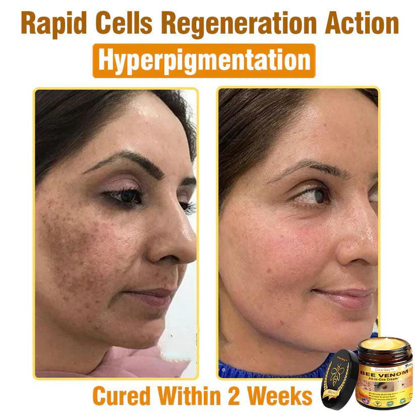 🔥FDA Approved: Bee Venom Skin Restoration Cream — 🔥Limited Time 80% OFF🔥