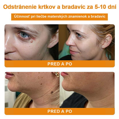 🧄𝑉𝑠𝑜𝑥𝑎™Velim Jędom Odsłanenij Bradavič Krém Znamionok (🧑‍⚕️AAD odporúča)🐝🐝(🔥Akcia na posledný deň - 80% zľava💒)🥔
