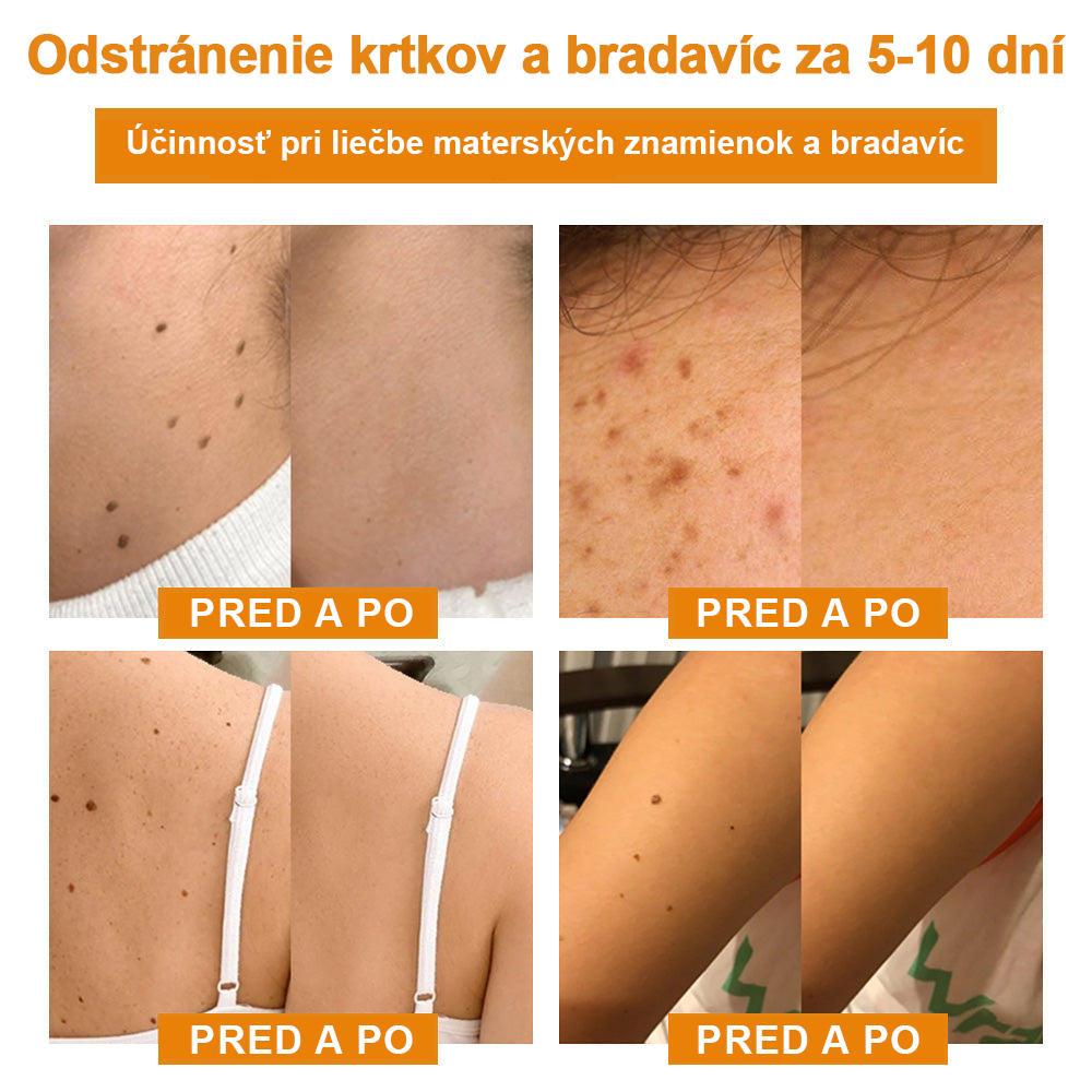 🧄𝑉𝑠𝑜𝑥𝑎™Velim Jędom Odsłanenij Bradavič Krém Znamionok (🧑‍⚕️AAD odporúča)🐝🐝(🔥Akcia na posledný deň - 80% zľava💒)🥔