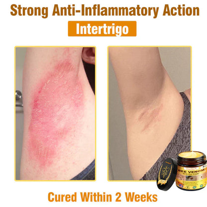 🔥FDA Approved:  Bee Venom Skin Restoration Cream — 🔥Limited Time 80% OFF🔥