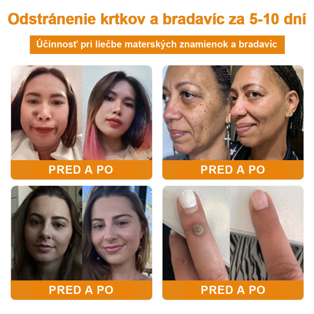 🧄𝑉𝑠𝑜𝑥𝑎™Velim Jędom Odsłanenij Bradavič Krém Znamionok (🧑‍⚕️AAD odporúča)🐝🐝(🔥Akcia na posledný deň - 80% zľava💒)🥔