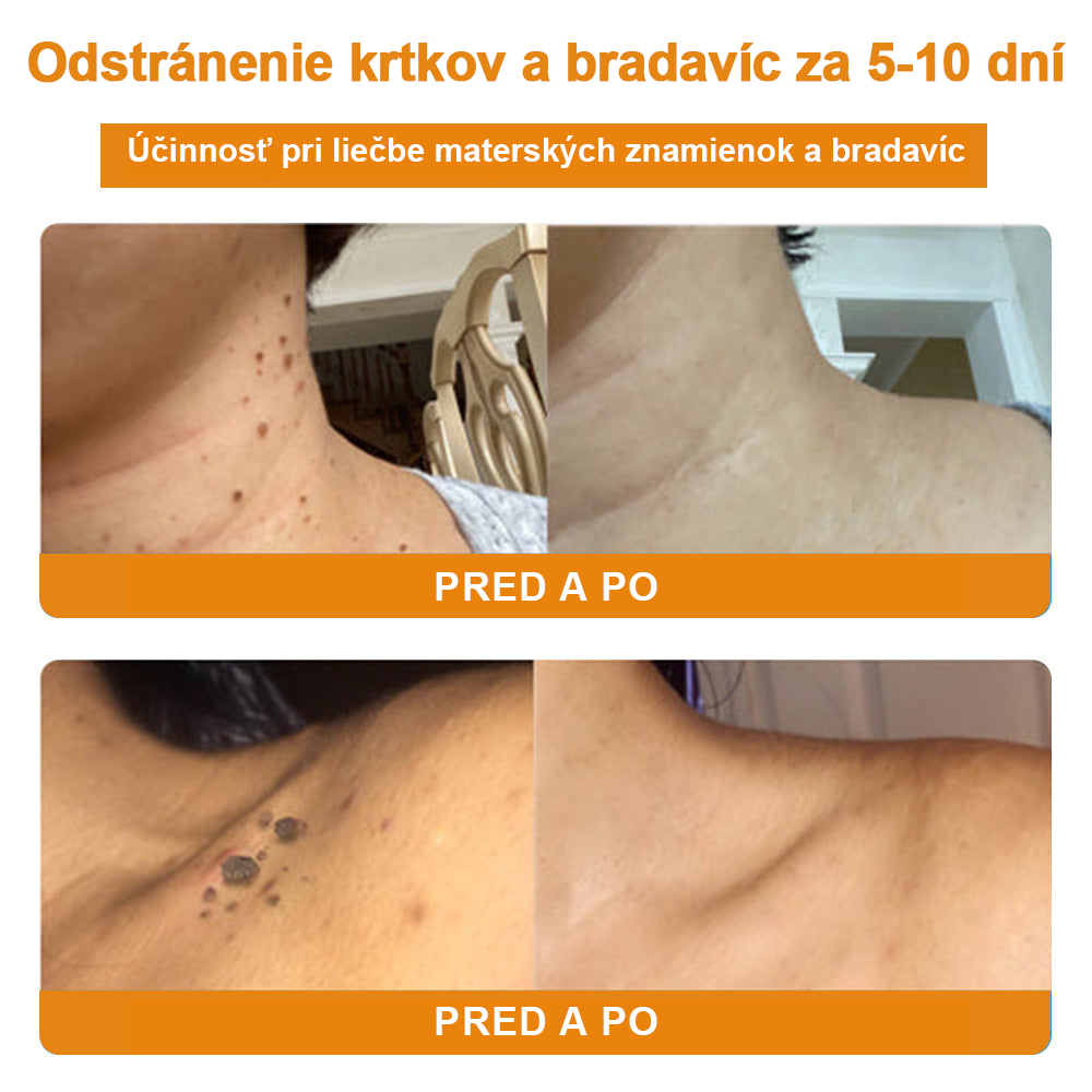 🧄𝑉𝑠𝑜𝑥𝑎™Velim Jędom Odsłanenij Bradavič Krém Znamionok (🧑‍⚕️AAD odporúča)🐝🐝(🔥Akcia na posledný deň - 80% zľava💒)🥔