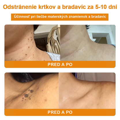 🧄𝑉𝑠𝑜𝑥𝑎™Velim Jędom Odsłanenij Bradavič Krém Znamionok (🧑‍⚕️AAD odporúča)🐝🐝(🔥Akcia na posledný deň - 80% zľava💒)🥔