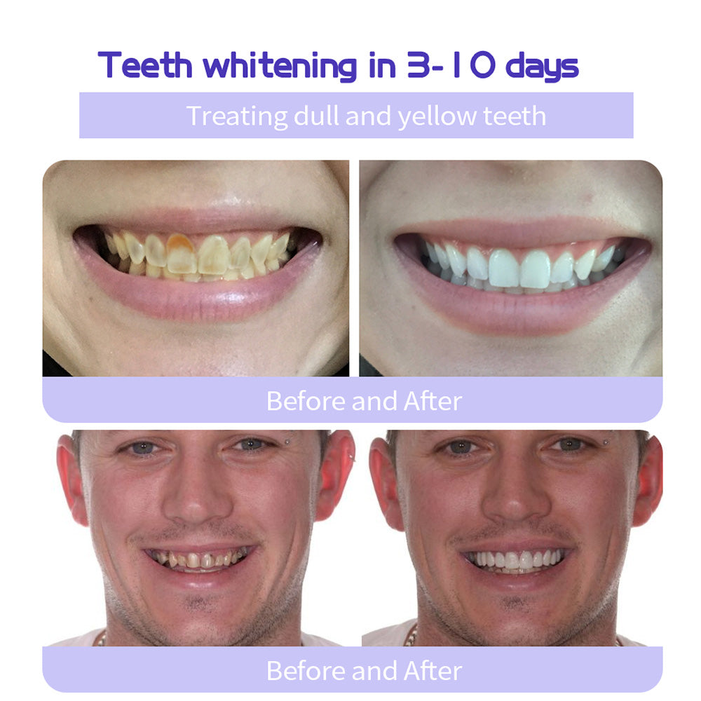 🔥Ends Tonight: Get 60% OFF Before It’s Gone!🎁 Fluoride-Free Hydroxyapatite Toothpaste – Gentle Whitening & Enamel Strength for Sensitive Teeth