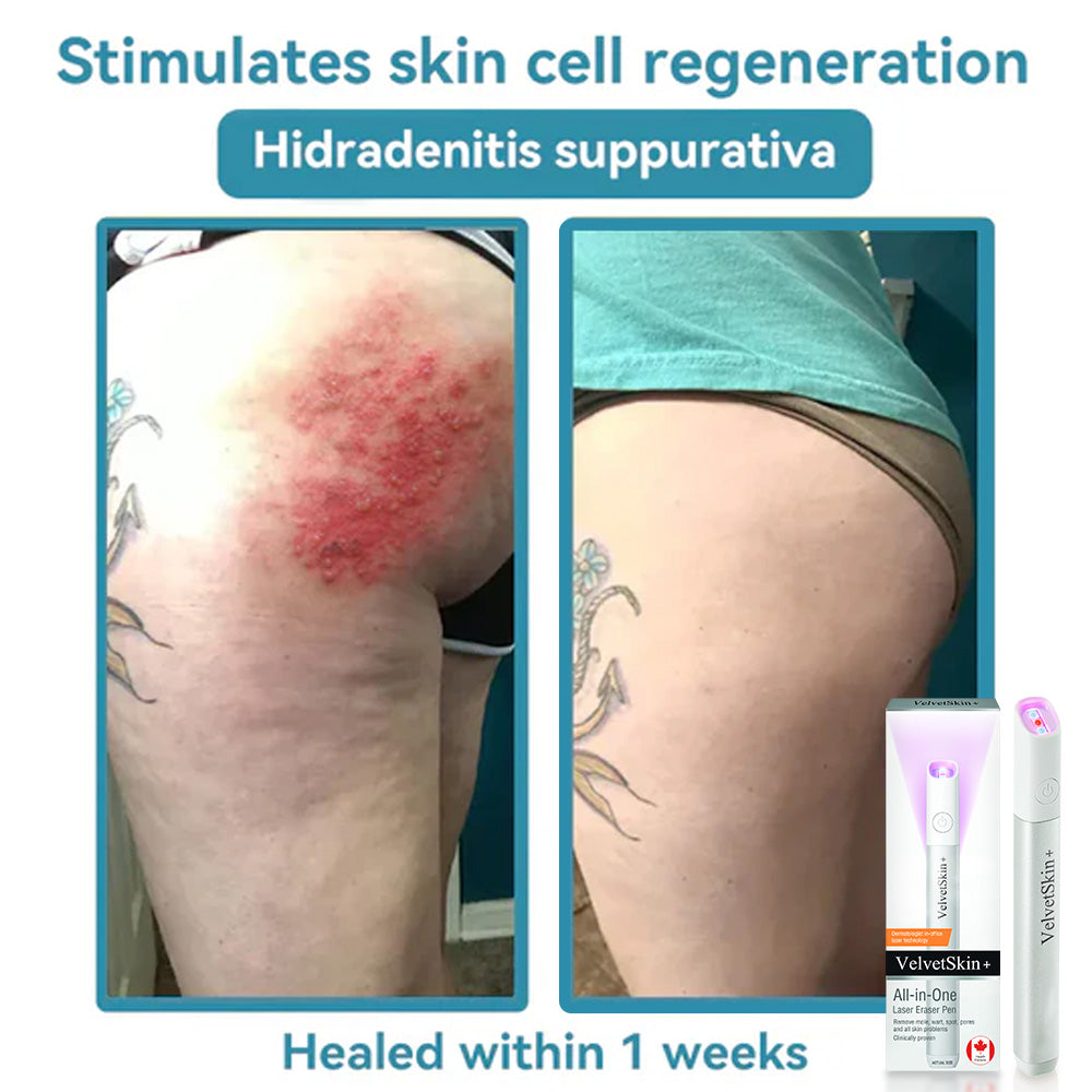 🛡️WishTint® VelvetSkin+ Integrated laser eraser ⚔︎(⚡powered by CO₂ laser technology - effectively removes moles, warts, skin labels, pigmentation spots and other skin defects)