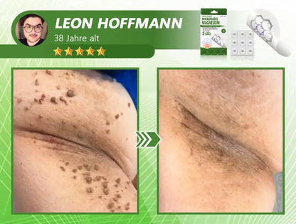 Ourlyard® Magnesium MicroNeedle Schnell Entfernen Hautmal-Pflaster