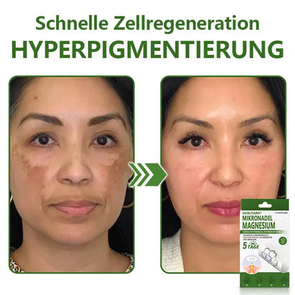 Ourlyard® Magnesium MicroNeedle Schnell Entfernen Hautmal-Pflaster