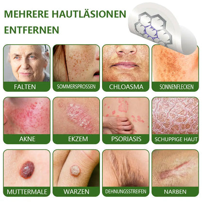 Ourlyard® Magnesium MicroNeedle Schnell Entfernen Hautmal-Pflaster