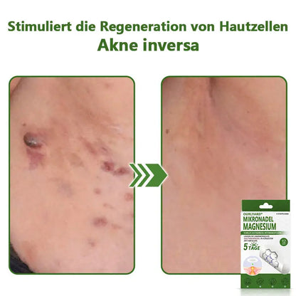 Ourlyard® Magnesium MicroNeedle Schnell Entfernen Hautmal-Pflaster
