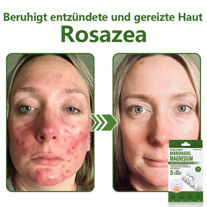 Ourlyard® Magnesium MicroNeedle Schnell Entfernen Hautmal-Pflaster