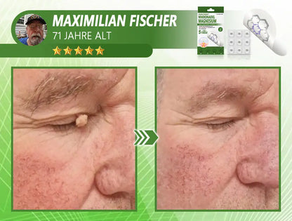 Ourlyard® Magnesium MicroNeedle Schnell Entfernen Hautmal-Pflaster