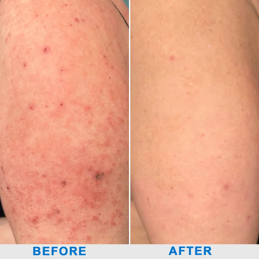 Ourlyard® Skin Treatment Cream
